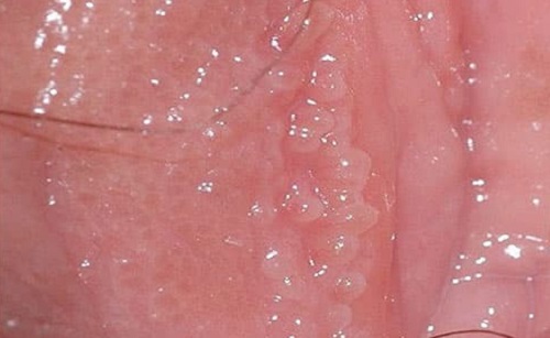 Mụn cóc vùng sinh dục ở nữ giới
